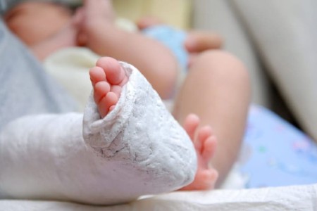 درمان مشکلات پا و اختلالات ساق پا در نوزادان 